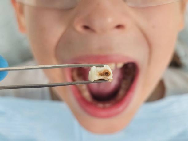Best Emergency Treatment for Oral Infections in Huntingdon, PA